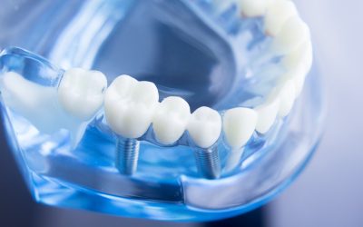 Improve your smile and oral health with dental crowns Port Macquarie NSW locals trust
